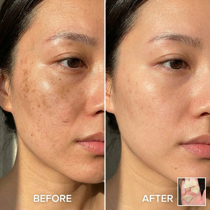 ByLux™ Hyperpigmentation Patch • Glutathione, Niacinamide & NAG